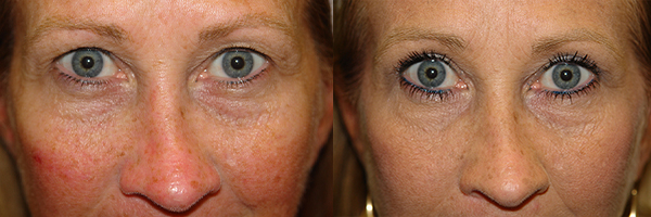 before and after blepharoplasty in the woodlands texas