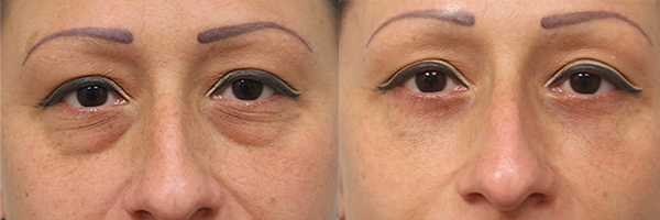 before and after eyelid surgery in the woodlands texas