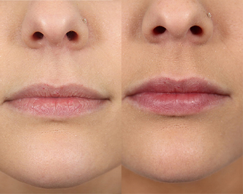before and after lip filler in shenandoah texas