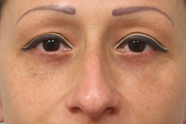 after blepharoplasty in the woodlands texas