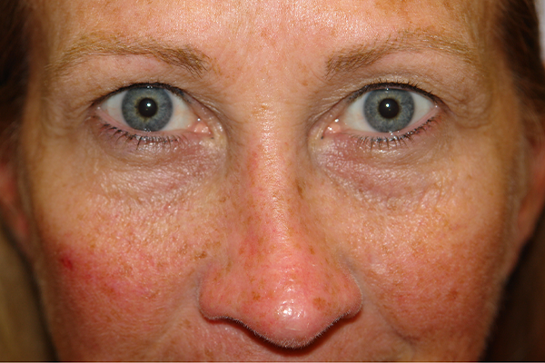 before eyelid surgery in the woodlands texas