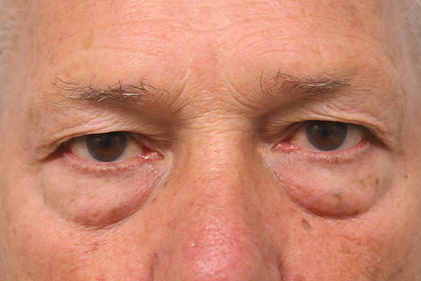 before blepharoplasty surgery in the woodlands texas