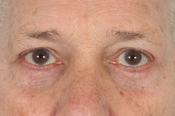 after blepharoplasty surgery in the woodlands texas