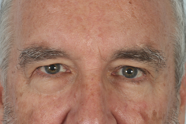 before male blepharoplasty in the woodlands texas