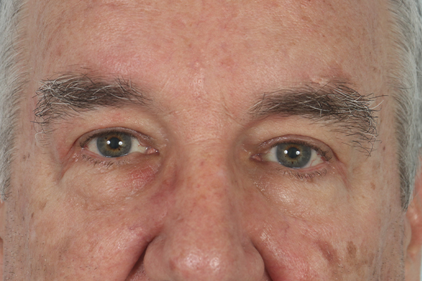 after male blepharoplasty in the woodlands texas